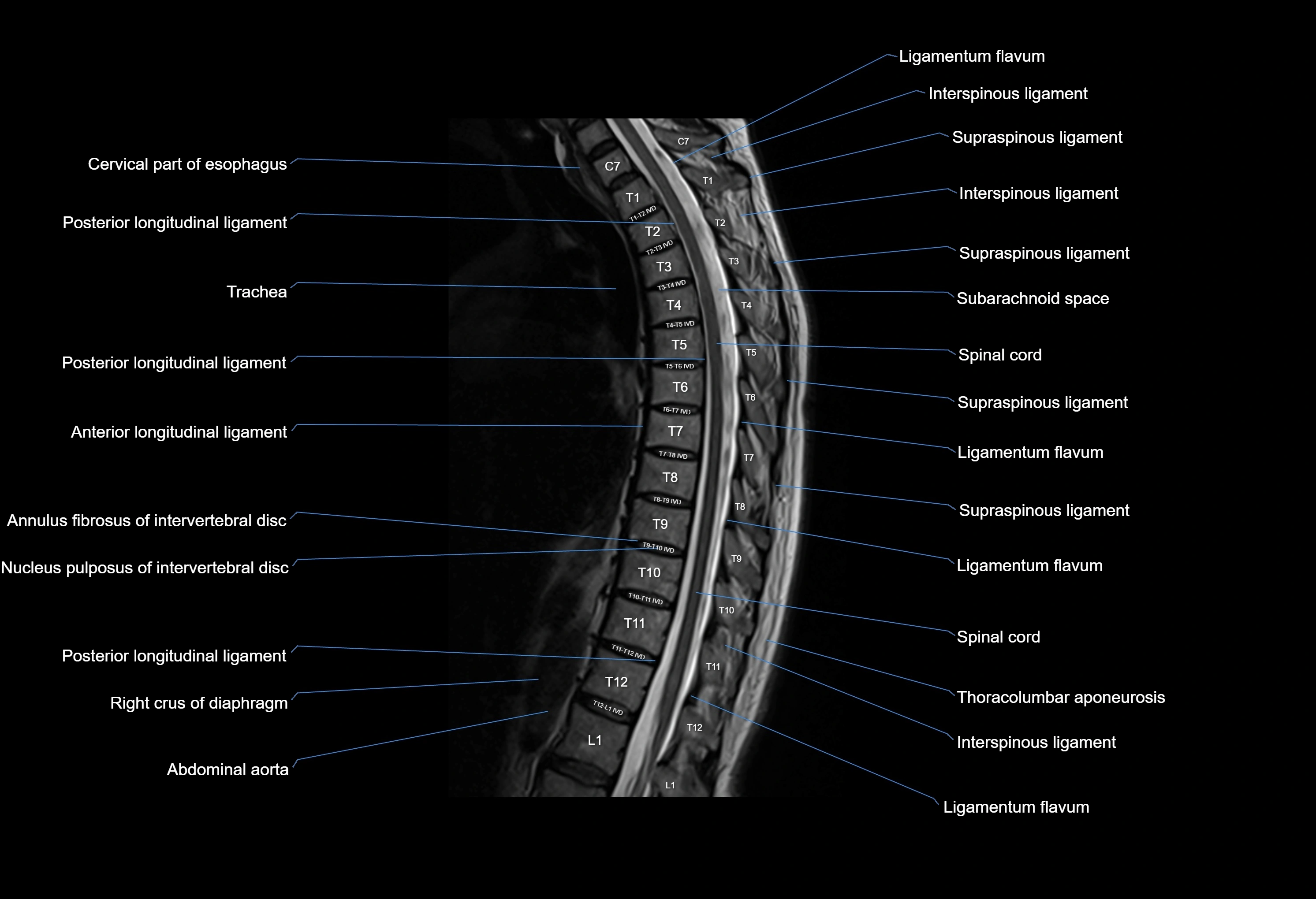MRI thoracic spine sagittal  cross sectional anatomy 3T radiology  image-img-00001-00013.webp